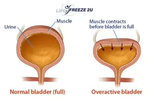 diagram of overactive bladder treatment Stockport