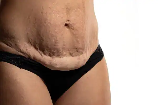 loose skin after weight loss injections Stockport