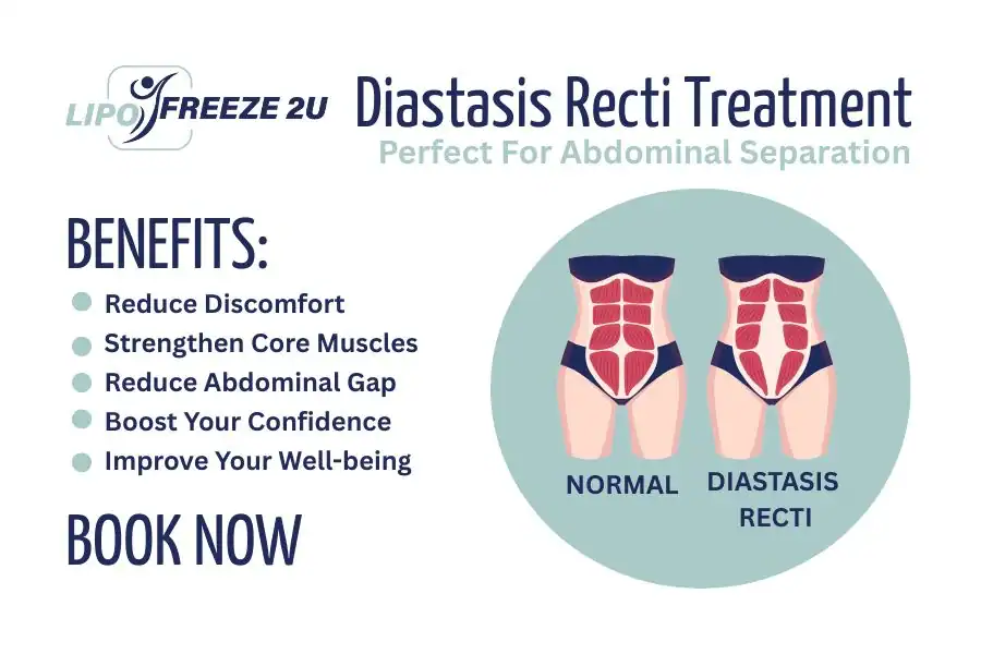 How Long Will It Take to See Improvements in Diastasis Recti Stockport
