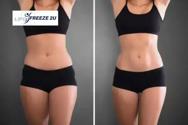 How Can LIPO FREEZE 2U Support Your Post-Pregnancy Body Recovery Stockport?