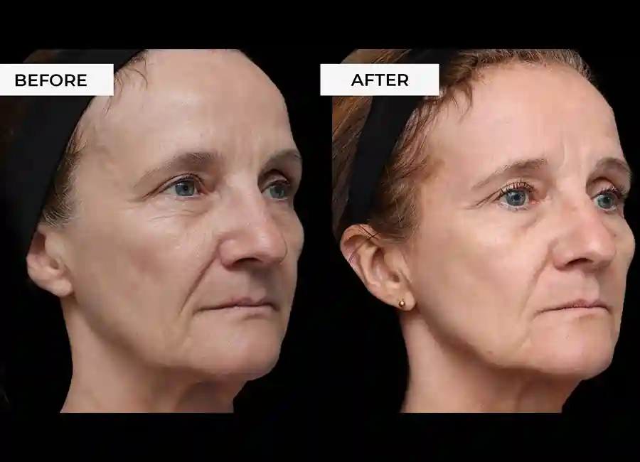 How Many RF Microneedling Sessions Will You Need to See a Difference Stockport?